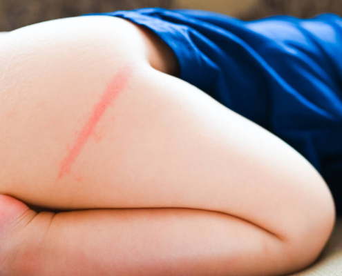 Baby with visible diaper rash on lower body, illustrating common symptoms of diaper irritation."